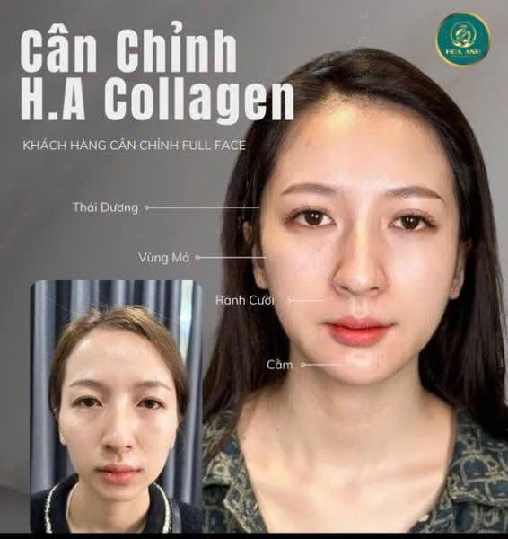Cân chỉnh HA Collagen full face tại Hoa Anh — ca 3